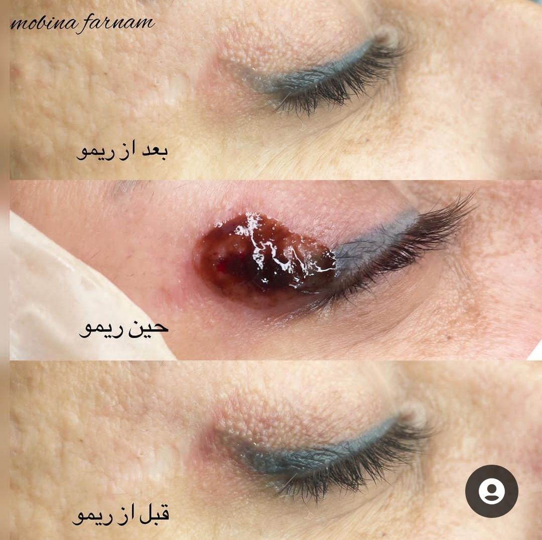 ریمو تتو خط چشم