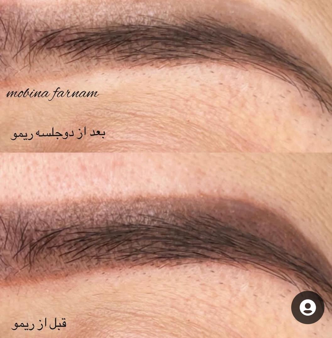 میکروبلیدینگ ابرو